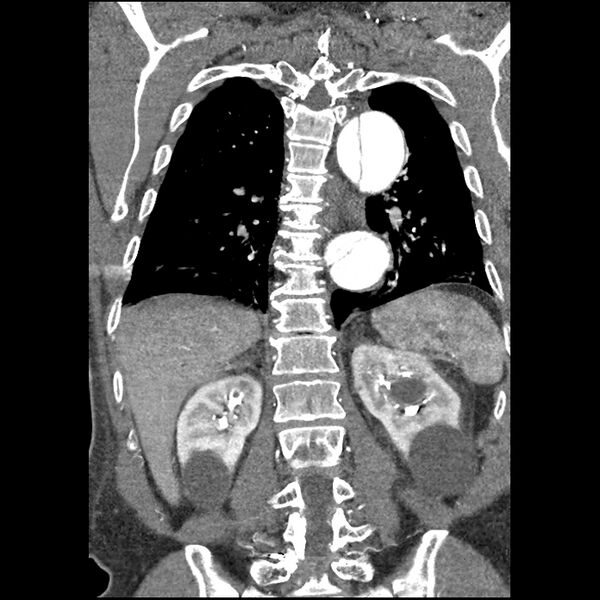 File:Aortic dissection - DeBakey Type I-Stanford A (Radiopaedia 79863-93115 B 28).jpg