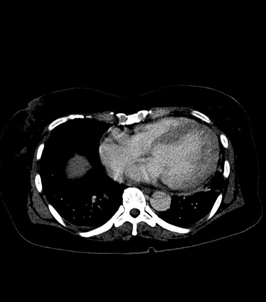 File:Aortic dissection with renal ischemia (Radiopaedia 76573-88338 B 18).jpg