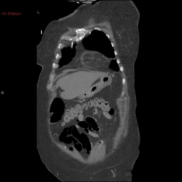 File:Aortic intramural hematoma (Radiopaedia 27746-28001 B 2).jpg