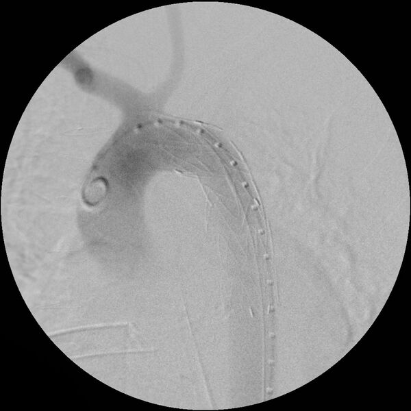 File:Aortic transection and subclavian steal (Radiopaedia 8711-9517 Stent 4).jpg