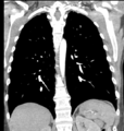 Aortic valve non-coronary cusp thrombus (Radiopaedia 55661-62189 C 54).png