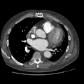 Aorto-coronary bypass graft aneurysms (Radiopaedia 40562-43157 A 67).png