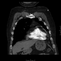 Aorto-coronary bypass graft aneurysms (Radiopaedia 40562-43157 B 9).png