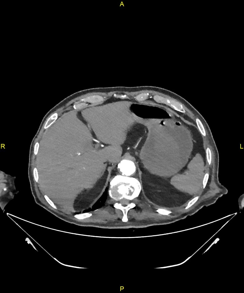 Aortoenteric fistula (Radiopaedia 84308-99603 B 55).jpg