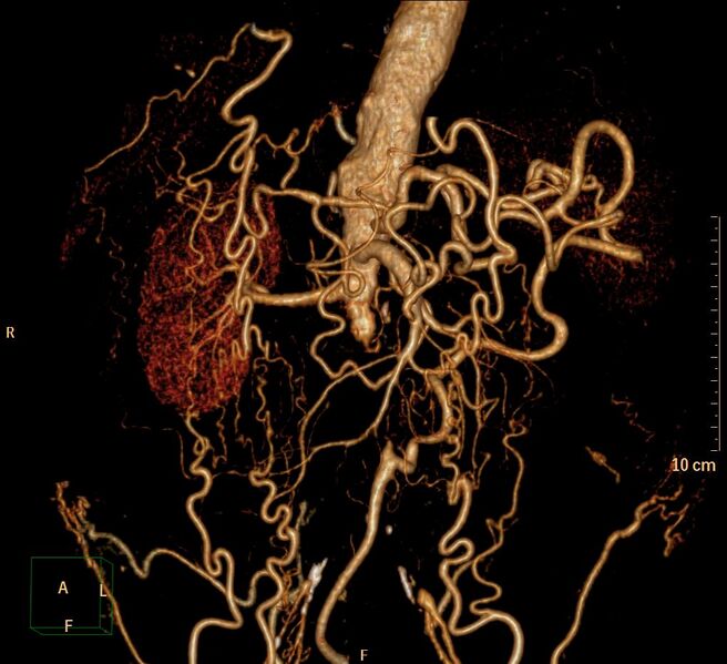 File:Aortoiliac occlusive disease (Radiopaedia 31376-32161 3D-VR-aorta 2).jpg