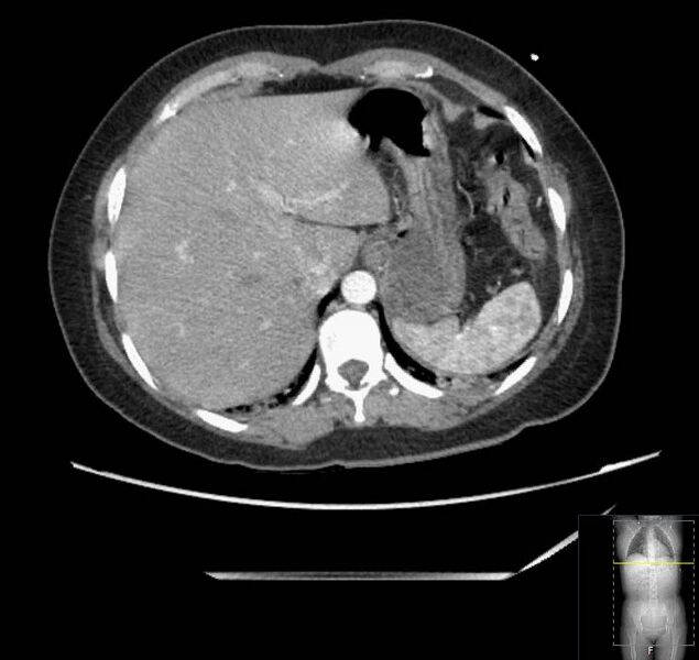 File:Appendicitis (CT angiogram) (Radiopaedia 154713-127660 Axial 163).jpg