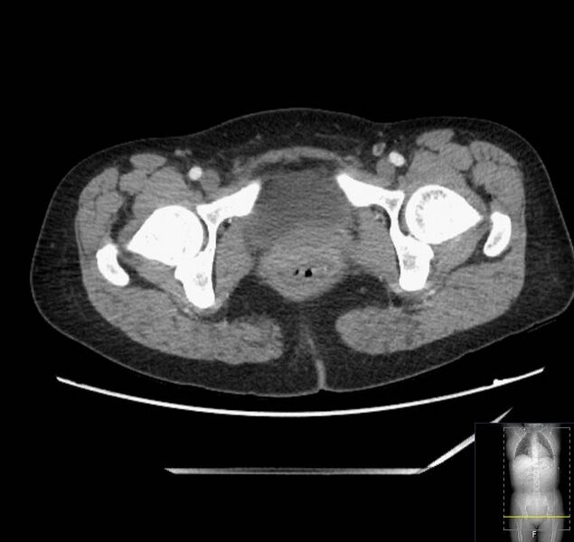 File:Appendicitis (CT angiogram) (Radiopaedia 154713-127660 Axial 78).jpg