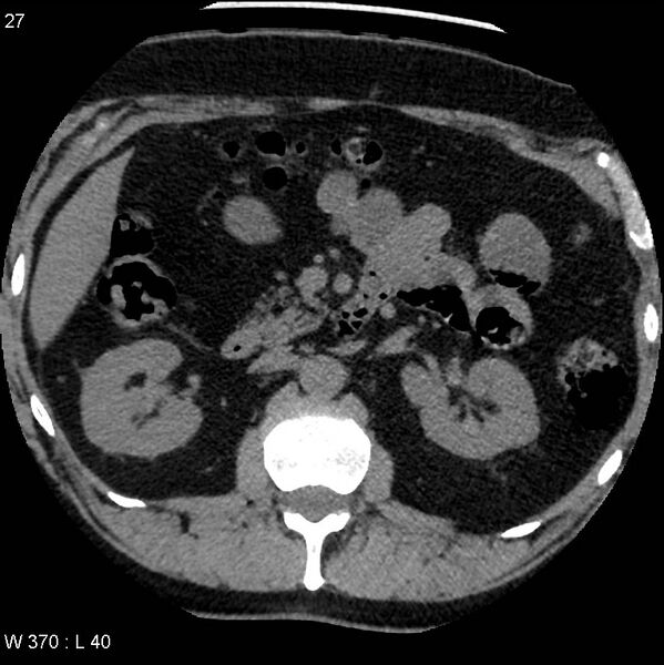 File:Appendicitis (Radiopaedia 12510-12733 Axial non-contrast 2).jpg