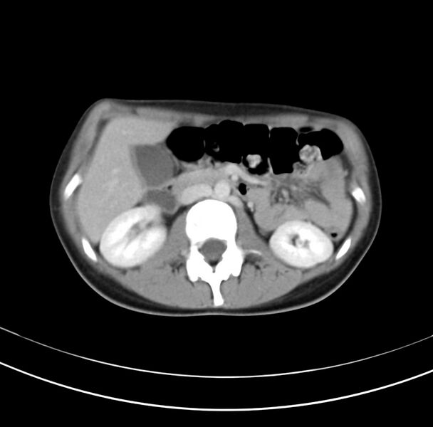 File:Appendicitis and incidental bicornuate uterus (Radiopaedia 22833-22853 B 17).jpg