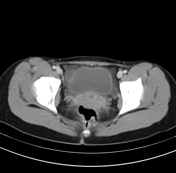 File:Appendicitis and incidental bicornuate uterus (Radiopaedia 22833-22853 B 43).jpg