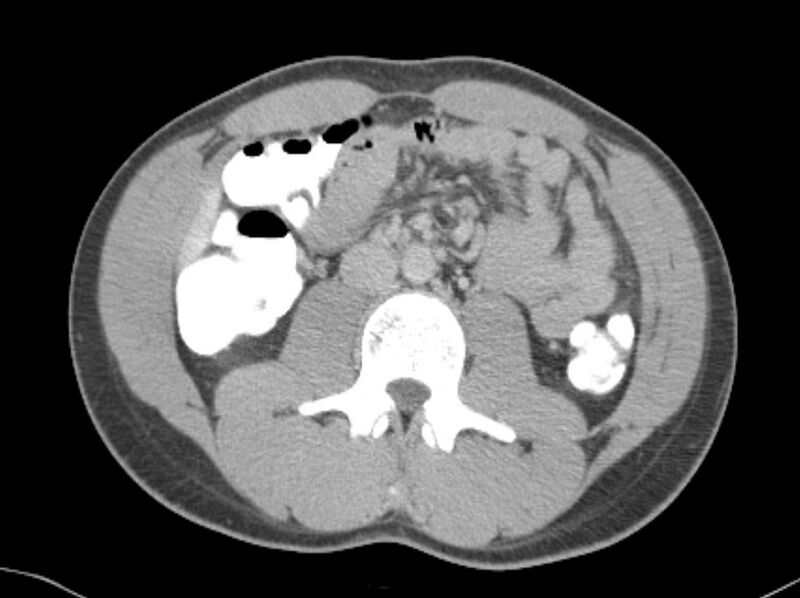 File:Appendicitis and incidental foregut duplication cyst (Radiopaedia 52962-58916 A 32).jpg
