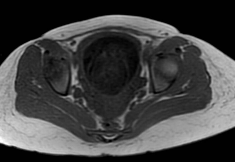 File:Appendicitis in gravida (MRI) (Radiopaedia 89433-106395 Axial T1 in-phase 62).jpg