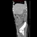 Appendicitis with phlegmon (Radiopaedia 9358-10046 F 10).jpg