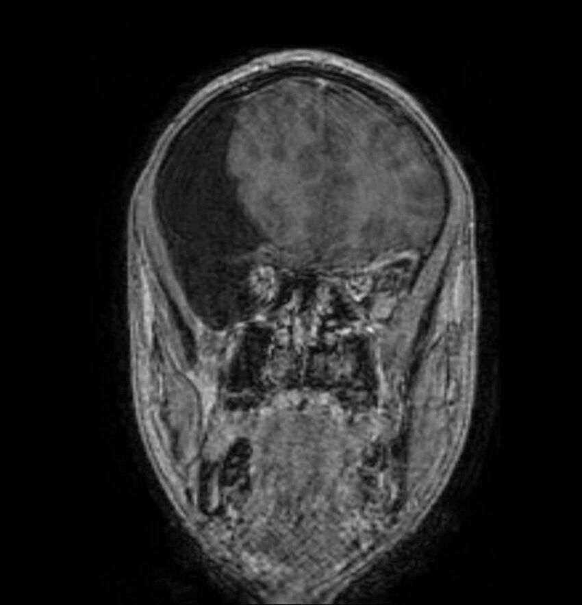 Arachnoid cyst- extremely large (Radiopaedia 68741-78451 Coronal T1 C+ 25).jpg