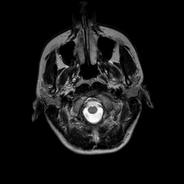 File:Arrested pneumatization of the sphenoid (Radiopaedia 10700-11173 Axial T2 1).jpg