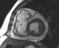 Arrhythmogenic right ventricular cardiomyopathy (Radiopaedia 69431-79307 Short axis cine 126).jpg