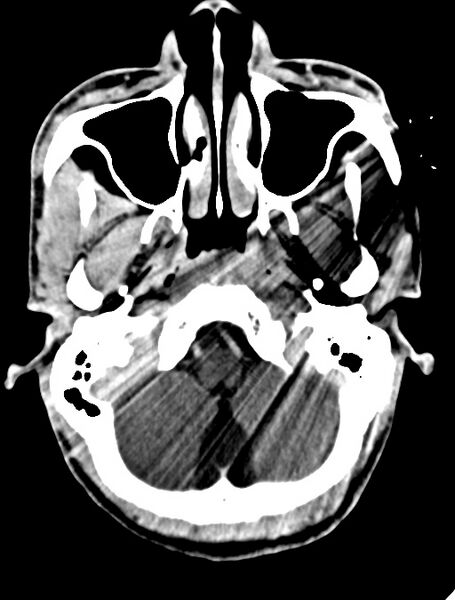 File:Arrow injury to the face (Radiopaedia 73267-84011 Axial C+ delayed 35).jpg