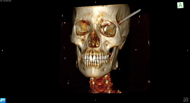 File:Arrow injury to the head (Radiopaedia 75266-86388 3D horizontal 3).jpg