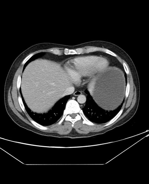 File:Arterial occlusive mesenteric ischemia (Radiopaedia 84641-100054 A 9).jpg