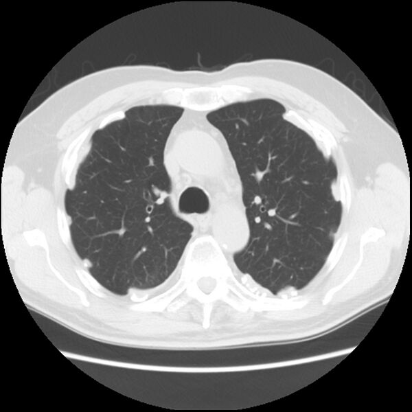 File:Asbestos-related pleural plaques (Radiopaedia 39069-41255 Axial lung window 24).jpg