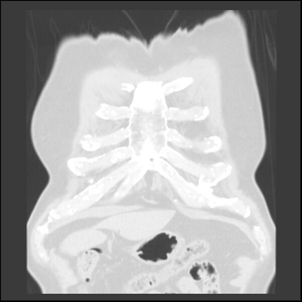 File:Asbestos-related pleural plaques (Radiopaedia 39069-41255 Coronal lung window 81).jpg