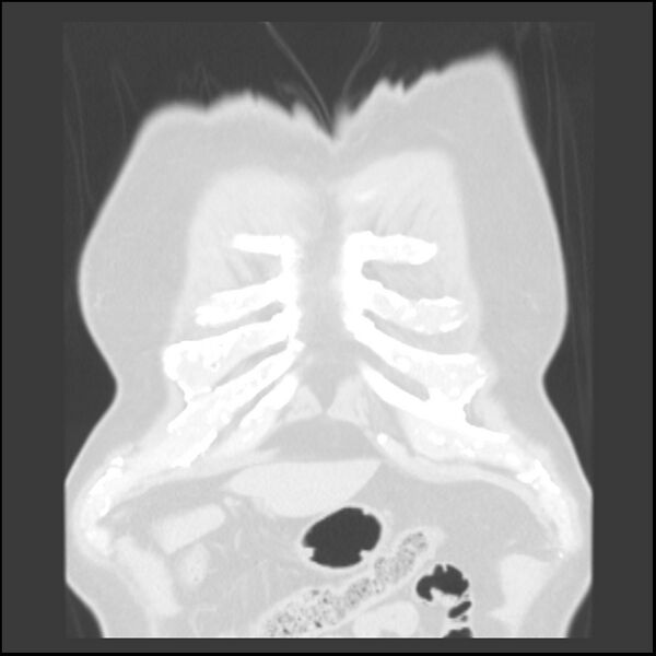 File:Asbestos-related pleural plaques (Radiopaedia 39069-41255 Coronal lung window 83).jpg