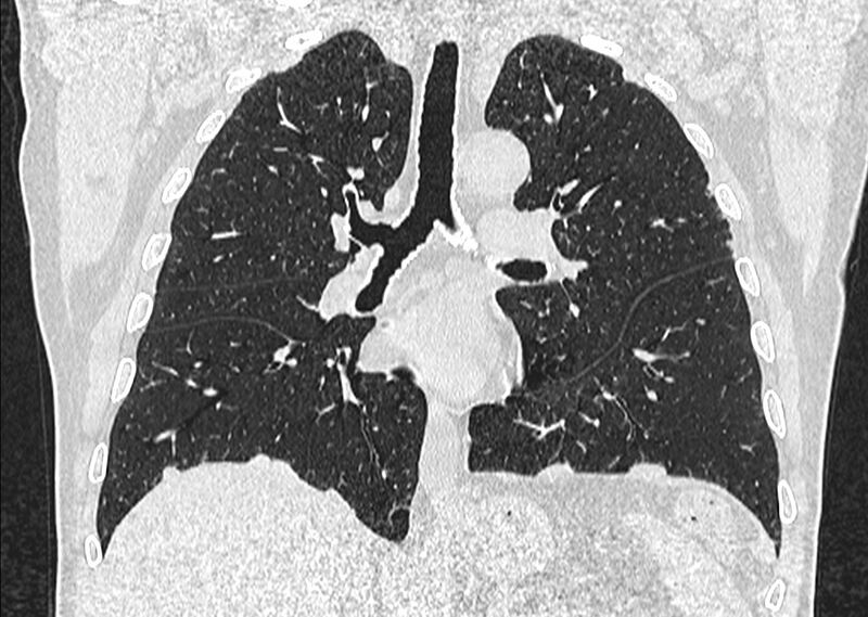 File:Asbestos pleural placques (Radiopaedia 57905-64872 Coronal lung window 154).jpg