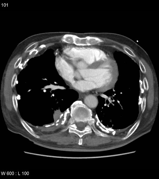File:Asbestos related lung and pleural disease (Radiopaedia 14377-14301 D 37).jpg