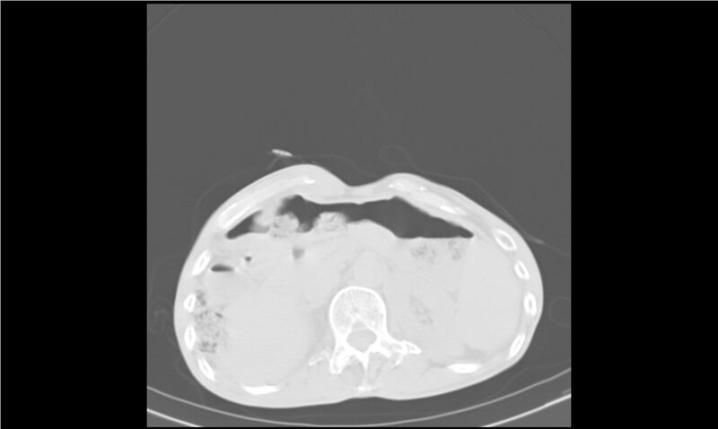 File:Aspergilloma (Radiopaedia 20788-20701 Axial lung window 40).jpg