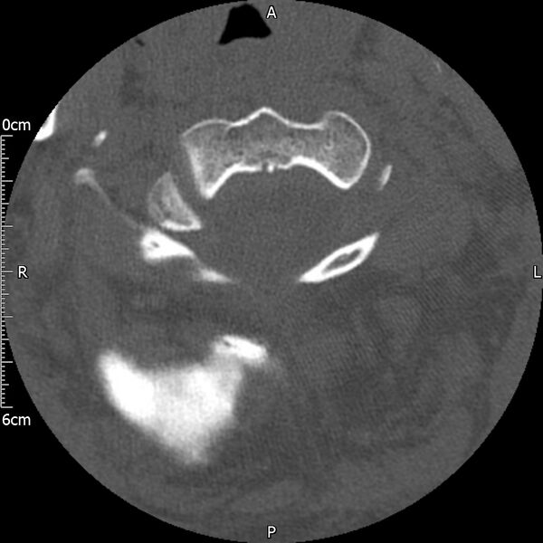 File:Atlas fracture with Currarino type A congenital defect (Radiopaedia 71747-82144 Axial bone window 47).jpg