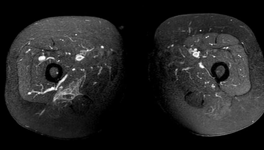 Atypical lipomatous tumor - thigh (Radiopaedia 68975-78734 Axial T1 C+ fat sat 65).jpg