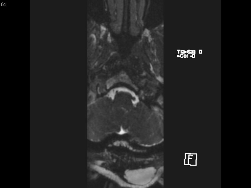 Atypical meningioma - intraosseous (Radiopaedia 64915-74572 Axial CISS 61).jpg