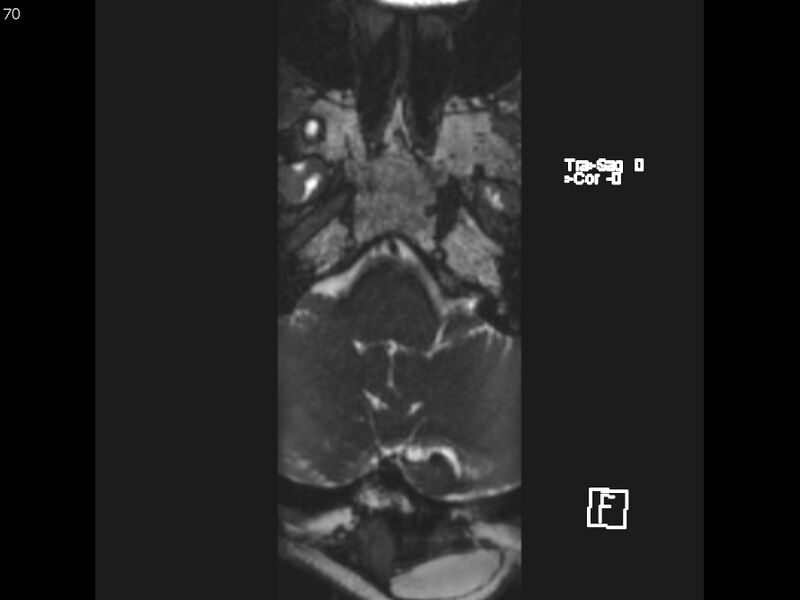 File:Atypical meningioma - intraosseous (Radiopaedia 64915-74572 Axial CISS 70).jpg