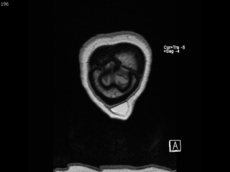 File:Atypical meningioma - intraosseous (Radiopaedia 64915-74572 Coronal T1 196).jpg