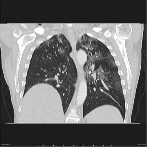File:Atypical pneumonia - Q fever (Radiopaedia 21993-21989 C 28).jpg
