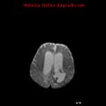 Atypical teratoid rhabdoid tumor (Radiopaedia 10712-11183 Axial DWI 5).jpg
