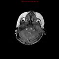 Atypical teratoid rhabdoid tumor (Radiopaedia 10712-11183 Axial FLAIR 14).jpg