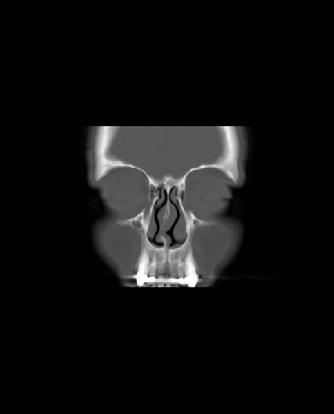 File:Automastoidectomy with labyrinthine fistula (Radiopaedia 84143-99411 Coronal non-contrast 10).jpg