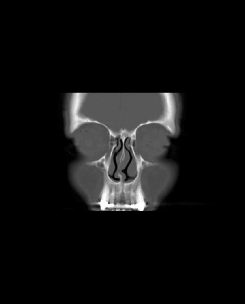 Automastoidectomy with labyrinthine fistula (Radiopaedia 84143-99411 Coronal non-contrast 10).jpg