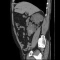Autosomal dominant polycystic kidney disease (Radiopaedia 36539-38101 D 31).jpg