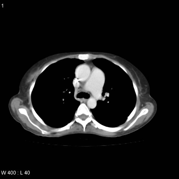 File:Autosomal dominant polycystic kidney disease with extensive hepatic involvement (Radiopaedia 10978).jpg