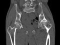 Avascular necrosis of the left hip (Radiopaedia 75068-86125 Coronal bone window 38).jpg
