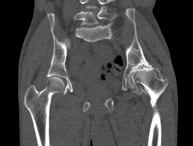 File:Avascular necrosis of the left hip (Radiopaedia 75068-86125 Coronal bone window 38).jpg