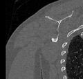Avulsion fracture - greater tuberosity of humerus (Radiopaedia 71216-81514 Coronal bone window 60).jpg