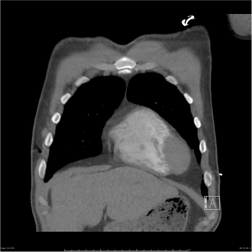 Azygos venous system anatomy (CT pulmonary angiography) (Radiopaedia 25928-26077 Coronal C+ CTPA 14).jpg