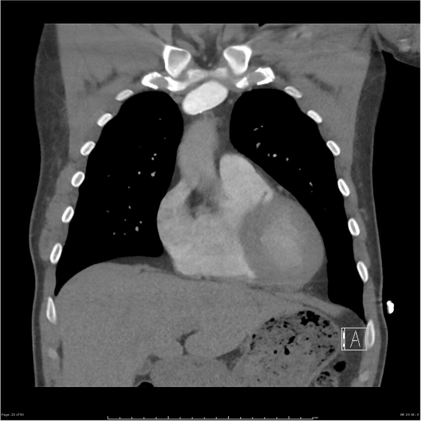 Azygos venous system anatomy (CT pulmonary angiography) (Radiopaedia 25928-26077 Coronal C+ CTPA 22).jpg