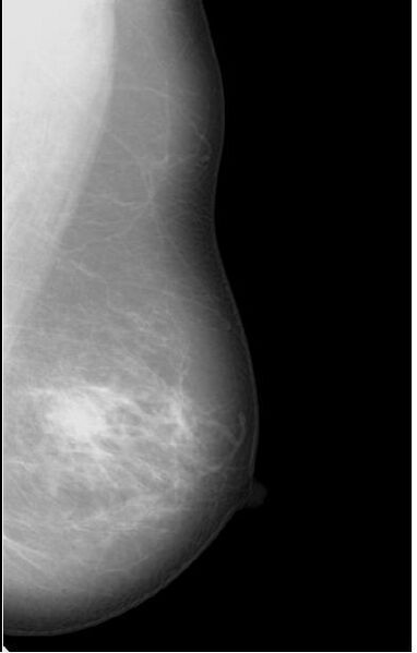 File:BIRADS II lesion - simple breast cyst (Radiopaedia 16526-16207 MLO 1).jpg