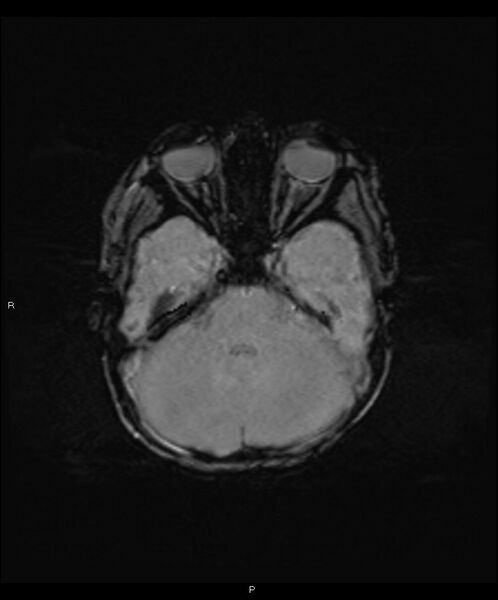 File:Basal ganglia and parenchymal ischemia (Radiopaedia 45818-50084 Axial SWI 13).jpg