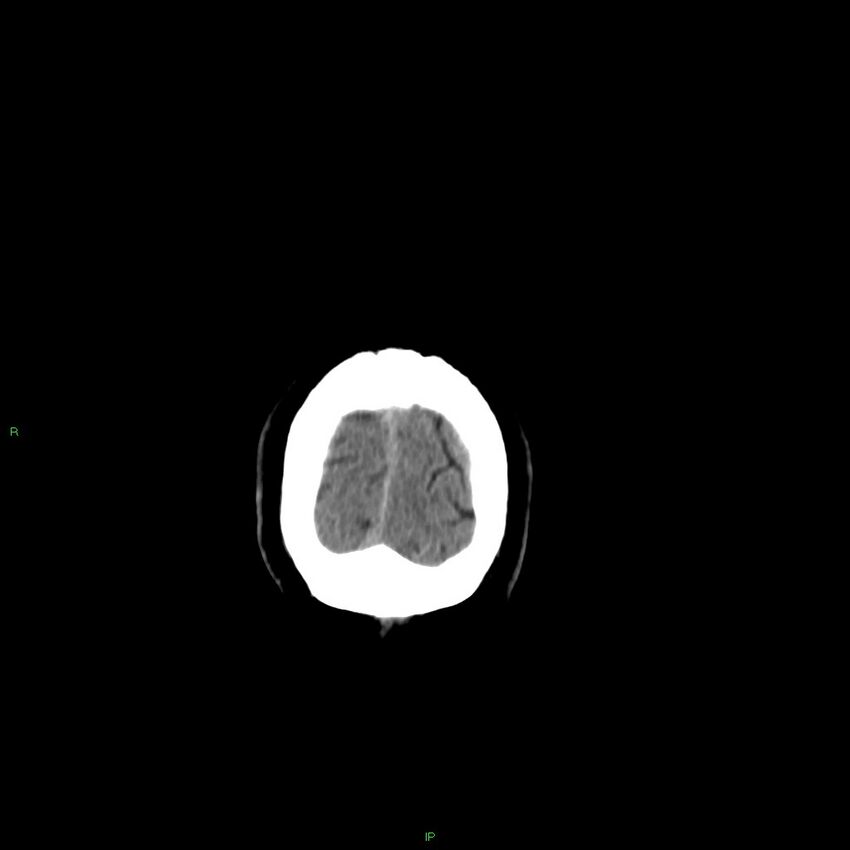 Basal ganglia hemorrhage (Radiopaedia 58346-65467 Coronal non-contrast 19).jpg