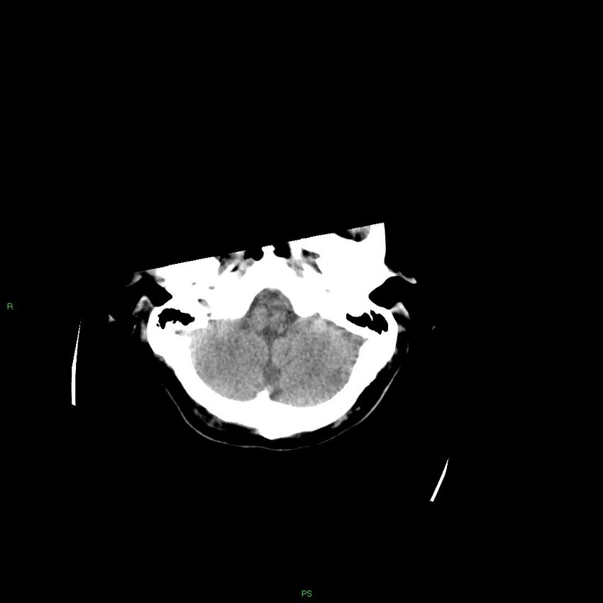 Basal ganglia hemorrhage (Radiopaedia 58349-65472 Axial non-contrast 48).jpg